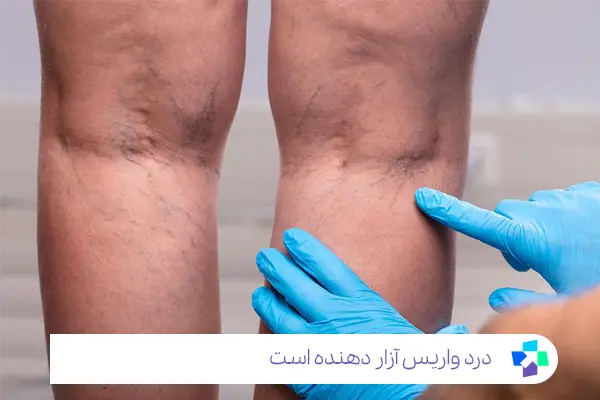 رگ های واریسی گاهی علت درد پا هستند|مجله طبی