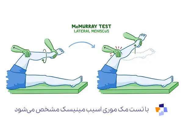تست مک موری برای تشخیص پارگی مینیسک زانو|مجله طبی