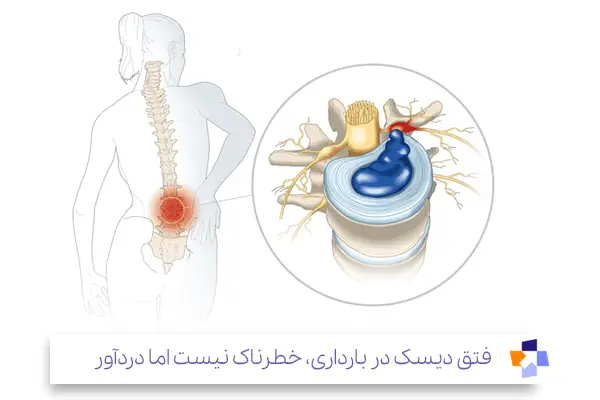 چه نوع کمر دردی در بارداری خطرناک است؟|مجله طبی