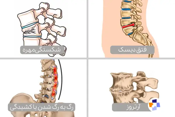 علت درد پایین کمر چیست؟|مجله طبی