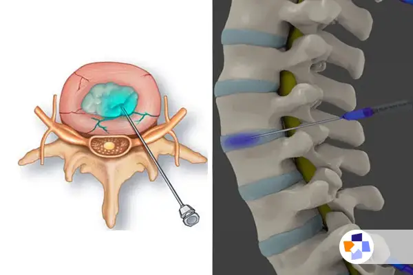 درمان سریع درد دیسک کمر با چندین روش موثر|مجله طبی