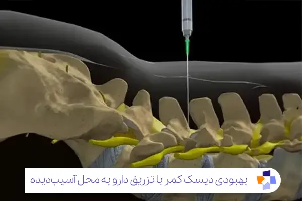 سوراخ کردن دیسک و کم کردن فشا در جراحی لیزری|مجله طبی