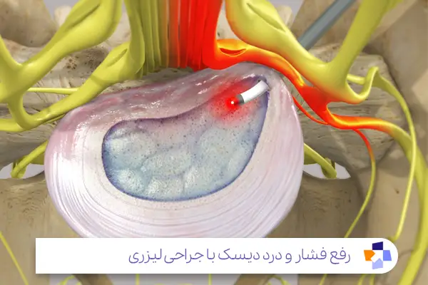 تزریق اپیدورال در جهت درمان سریع درد سیاتیک کمر|مجله طبی