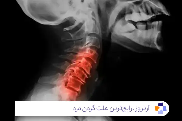 علت گردن درد ناگهانی چیست؟ معمولا آرتروز|مجله طبی