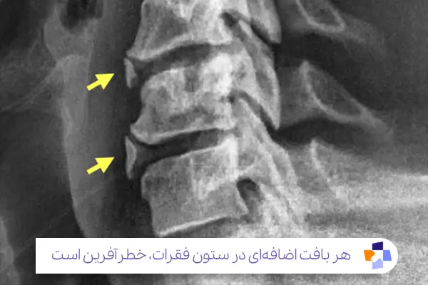 علت‌های رادیکولوپاتی گرفتگی عصب گردن|مجله طبی