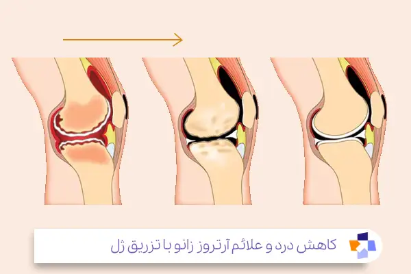 اثرات تزریق ژل بر علائم زانو درد بیمار|مجله طبی