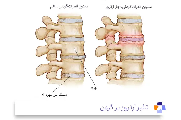 انواع آرتروز گردن|مجله طبی