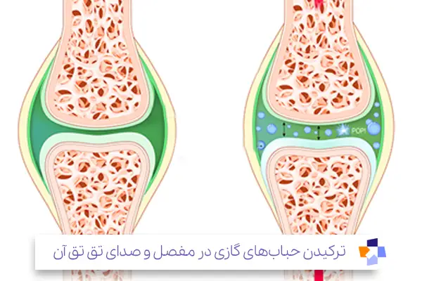 گازهای محبوس شده در مایع سینوویال: علت اصلی تق تق زانو بدون درد!|مجله طبی