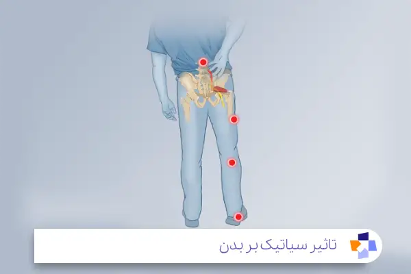 بهبود درد حاد سیاتیک؛ در عرض چند هفته|مجله طبی