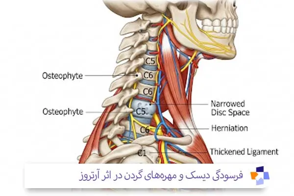 درمان آرتروز گردن در منزل | مجله طبی