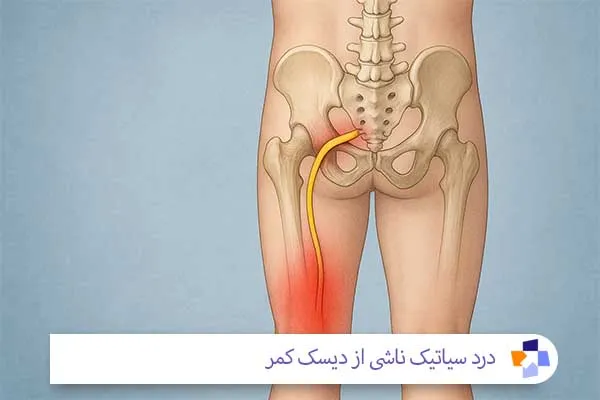 درد سیاتیک در اثر دیسک کمر | مجله طبی