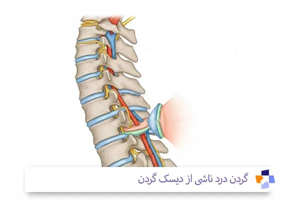 درد پشت گردن در اثر فتق دیسک | مجله طبی