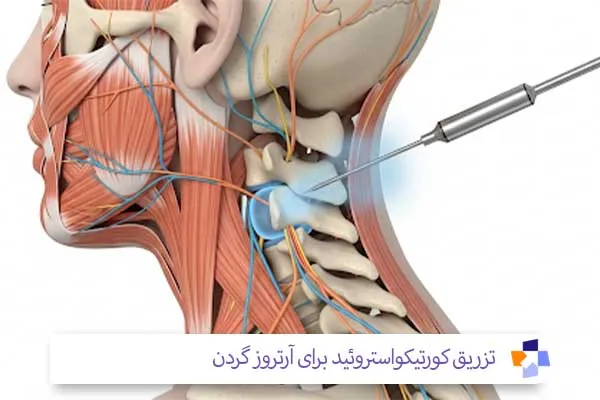 تزریق کورتیکواستروئید برای آرتروز گردن | مجله طبی