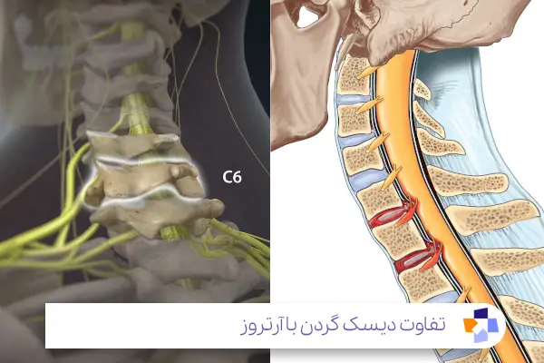 فرق دیسک گردن با آرتروز گردن چیست؟|مجله طبی