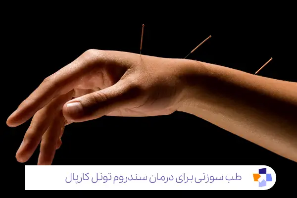 درمان تنگی کانال مچ دست با طب سوزنی: احیای انرژی و تسکین علائم|مجله طبی