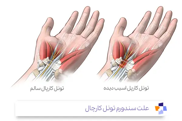 علت سندورم تونل کارچال|مجله طبی