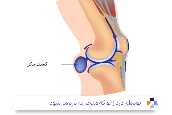 کیست بیکر (Baker’s Cyst)؛ از علت‌های زانو درد هنگام نشستن و برخاستن|مجله طبی