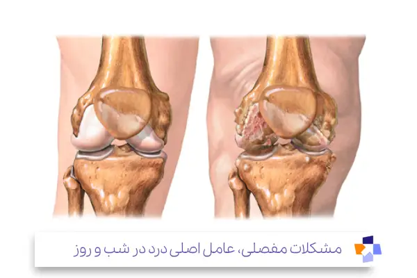 مشکلات مفصلی مثل آرتروز ؛ علت درد دست و پا در شب|مجله طبی