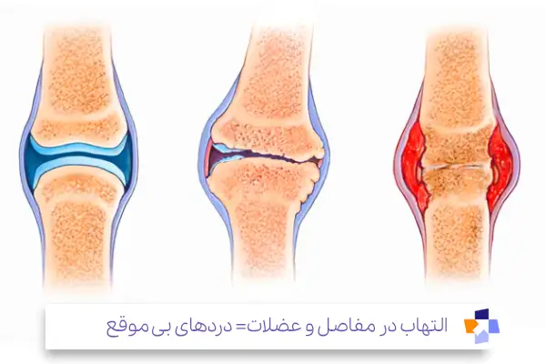 بیماری‌های مزمن التهابی؛ وقتی التهاب مزمن باعث درد شبانه مفاصل می‌شود|مجله طبی