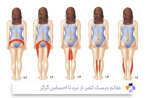 علائم دیسک کمر متناسب با محل آسیب دیدگی|مجله طبی