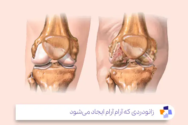 استئوآرتریت و نقش آن در زانودرد|مجله طبی