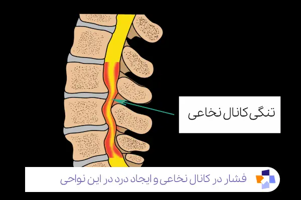 مشکلات ستون فقرات و ارتباط آن با درد زیر شکم|مجله طبی