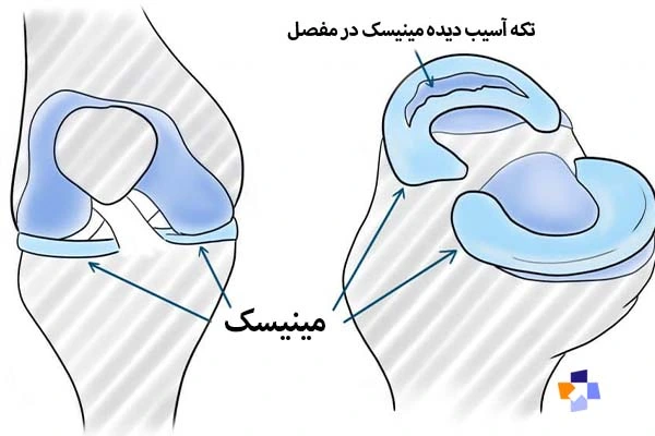 پارگی مینیسک زانو و قفل شدن زانو | مجله طبی