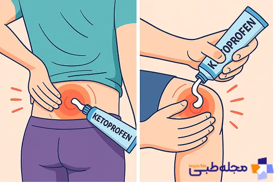 نحوه مصرف پماد کتوپروفن | مجله طبی