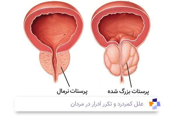 علت کمردرد و تکرر ادرار در مردان | مجله طبی