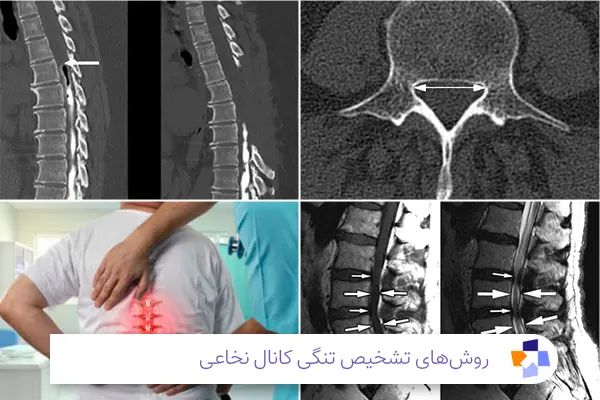 تشخیص تنگی کانال نخاعی | مجله طبی 