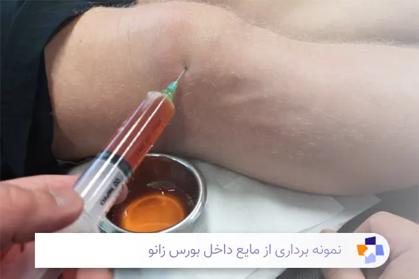 تشخیص بورسیت زانو | مجله طبی