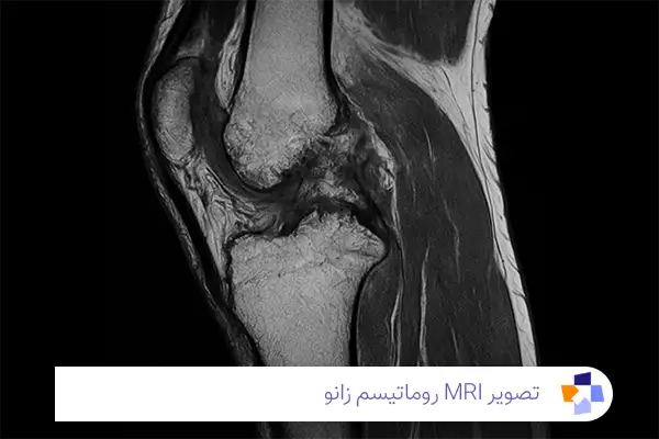 عکس mri روماتیسم زانو | مجله طبی
