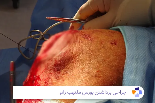 جراحی بورسیت زانو | مجله طبی
