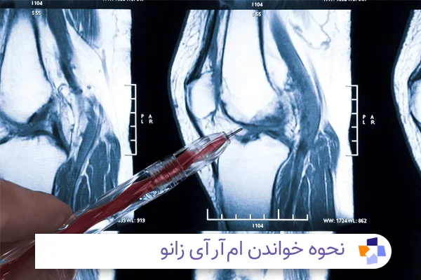 خواندن ام آر آی زانو | مجله طبی
