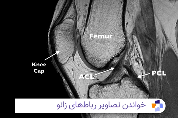 خواندن mri زانو | مجله طبی
