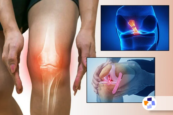 تفاوت پارگی و کشیدگی رباط زانو | مجله طبی
