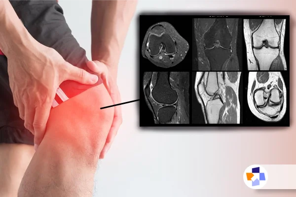 ام آر آی زانو | مجله طبی