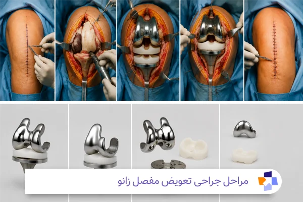 مراحل جراحی تعویض مفصل زانو| مجله طبی