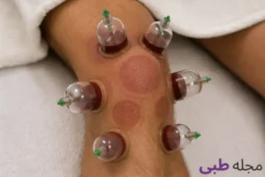 بررسی اثرات منفی و مثبت حجامت زانو