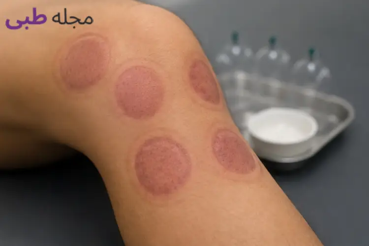 عوارض حجامت زانو