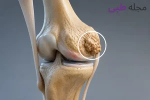 استخوان اضافه در زانو چیست و چگونه درمان می شود