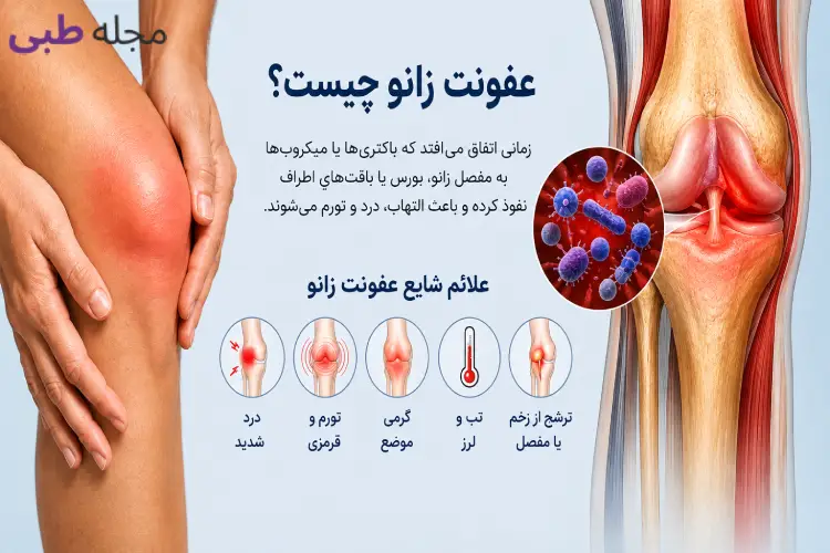 عفونت زانو؛ علائم و نشانه ها